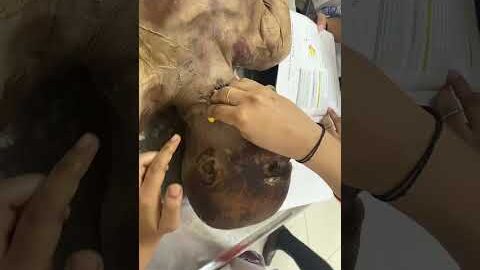 Head and neck surface marking