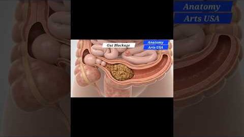 Illustration of Gut Blockage | Gut Health | Anatomy Arts USA