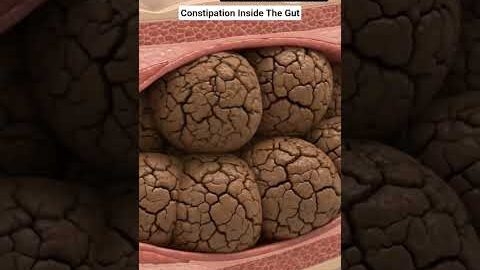 Illustration of constipation inside the gut | Gut Health | Body Arts Anatomy 3D