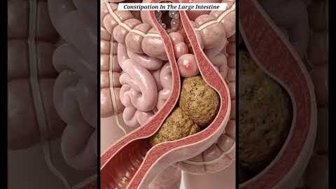 Illustration of Constipation In The Large Intestine | Gut Health | Anatomy Arts USA