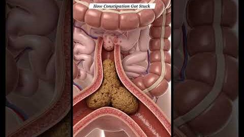 How Constipation Got Stuck | Gut Health | Anatomy Arts USA