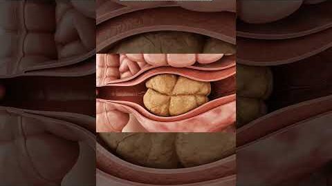 Illustration of stuck constipation | Gut Health | Body Arts Anatomy 3D