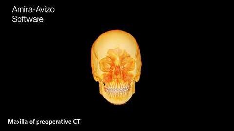 Postoperative evaluation of orthognathic patients with Amira Software
